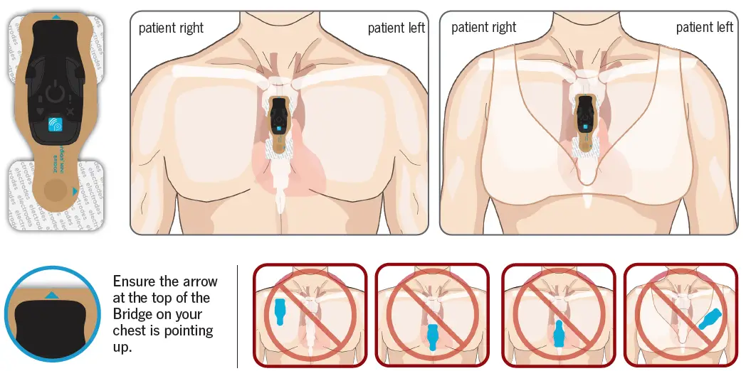 Body-Guardian-Mini-Plus-Preventice-Solutions-Patient-10